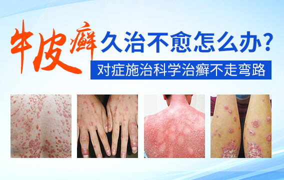 预防牛皮癣入侵 哪些事情要留意